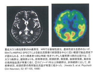 頭部MRIの写真